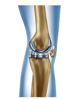 Joint Knee Replacement