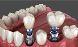 Dental Implant
