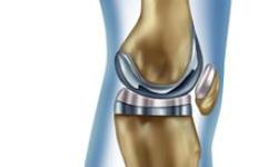 Joint Knee Replacement