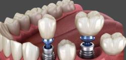 Dental Implant