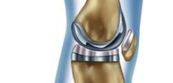 Joint Knee Replacement